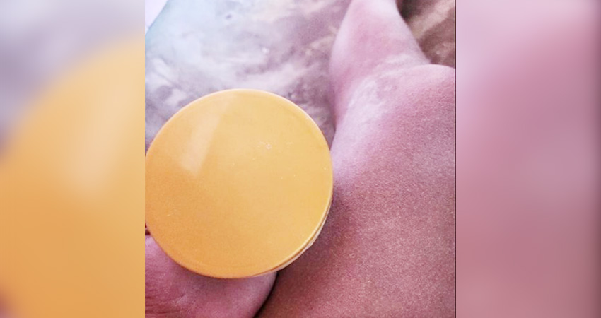 Kulit bagian kaki korban alami gatal-gatal dan melepuh mirip cacar air diduga setelah gunakan kosmetik tanpa ijin BPOM. (Foto: Istimewa).